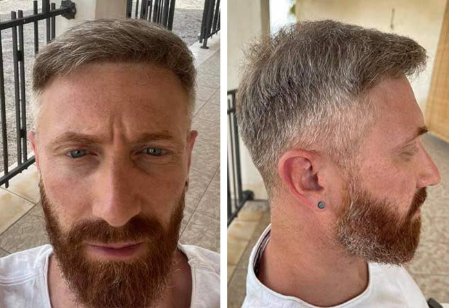 بعد 7 شهور عملية زراعة الشعر للسيد رفاييل مركز اليت هير