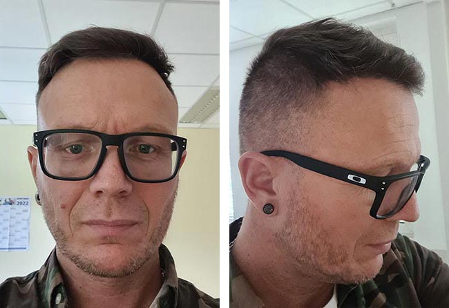 بعد 7 شهور عملية زراعة الشعر للسيد ستيفن مركز اليت هير