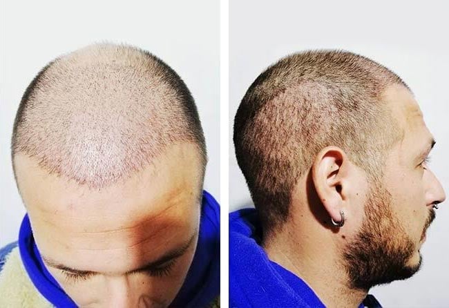 بعد شهر عملية زراعة الشعر للسيد خورخي مركز اليت هير