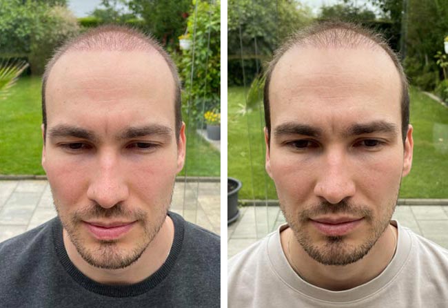 بعد شهرين زراعة الشعر للسيد مارسيل | مركز اليت هير