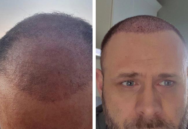 بعد شهرين عملية زراعة الشعر للسيد مايكل | اليت هير