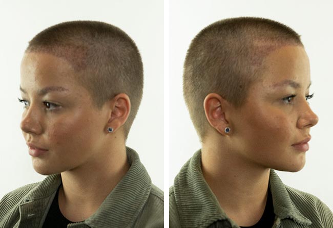 بعد شهرين عملية زراعة الشعر للسيدة ليليانا مركز اليت هير