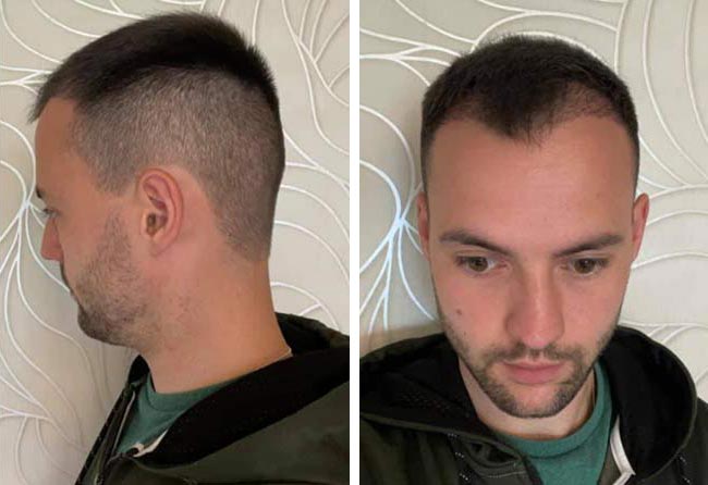 بعد شهرين من عملية زراعة الشعر للسيد اليكسنرا | مركز إليت هير