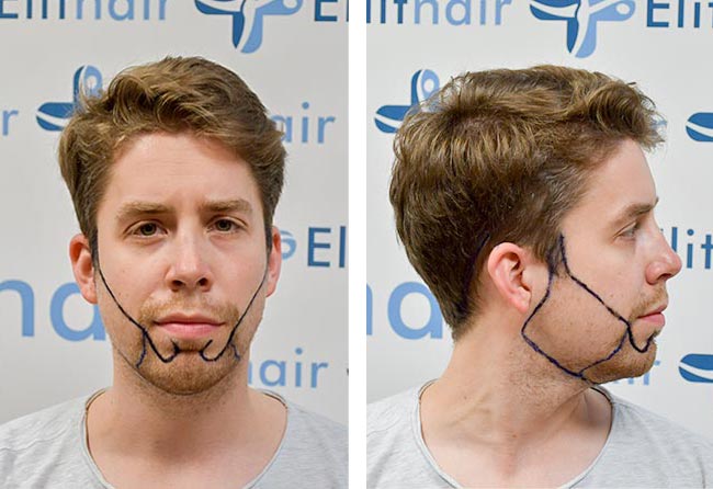 زراعة شعر قبل للسيد إيكي مركز اليت هير