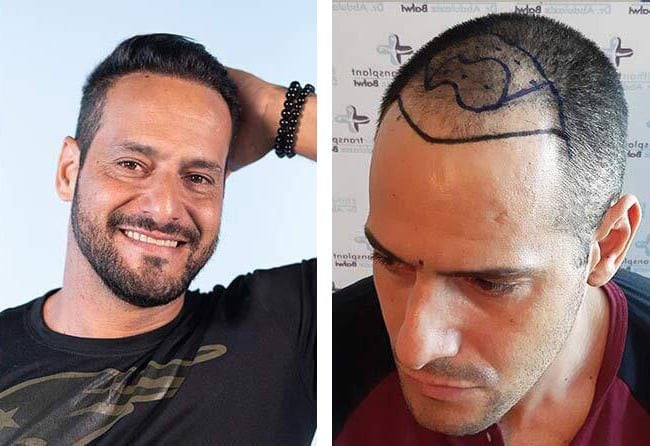 زراعة شعر قبل وبعد للسيد راوديرسون مركز اليت هير