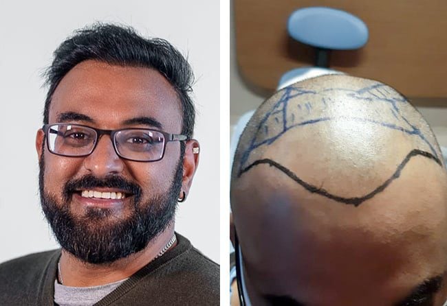 زراعة شعر قبل وبعد للسيد شهيد مركز اليت هير