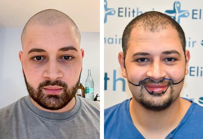 زراعة شعر قبل وبعد للسيد محمد مركز اليت هير