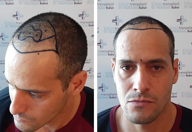 قبل زراعة شعر للسيد راوديرسون مركز اليت هير