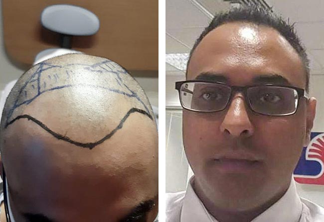 قبل زراعة شعر للسيد شهيد مركز اليت هير