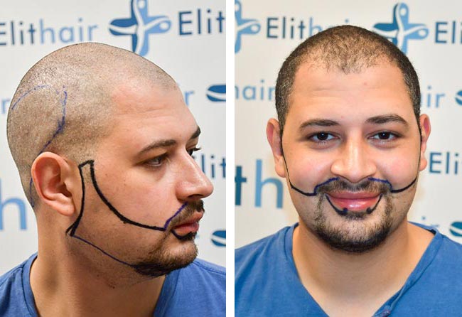 قبل زراعة شعر للسيد محمد مركز اليت هير