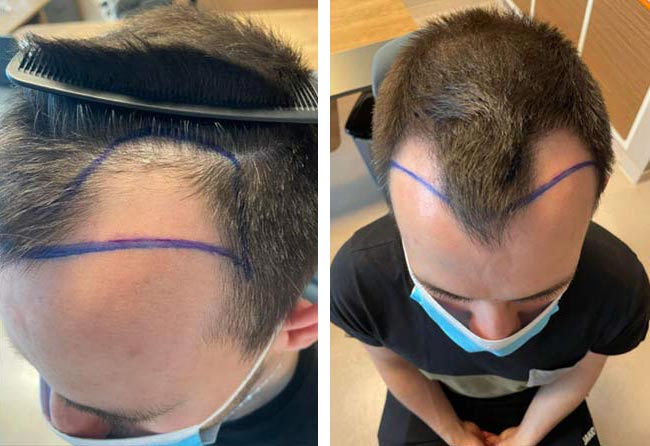 قبل عملية زراعة الشعر للسيد اليكسنرا | بمركز اليت هير
