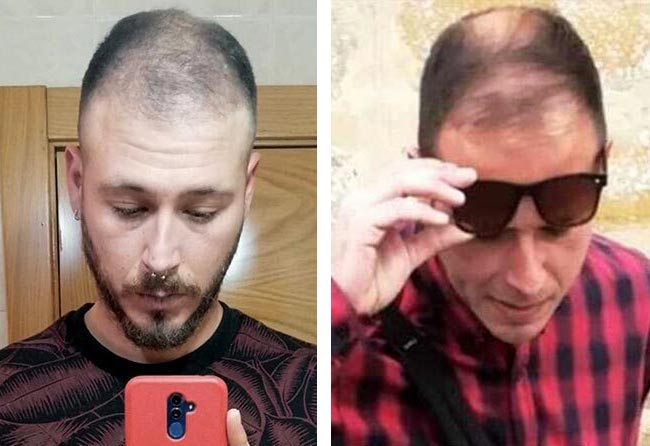 قبل عملية زراعة الشعر للسيد خورخي مركز اليت هير