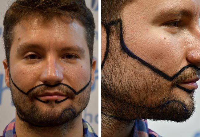 قبل عملية زراعة الشعر للسيد دومينيك | اليت هير