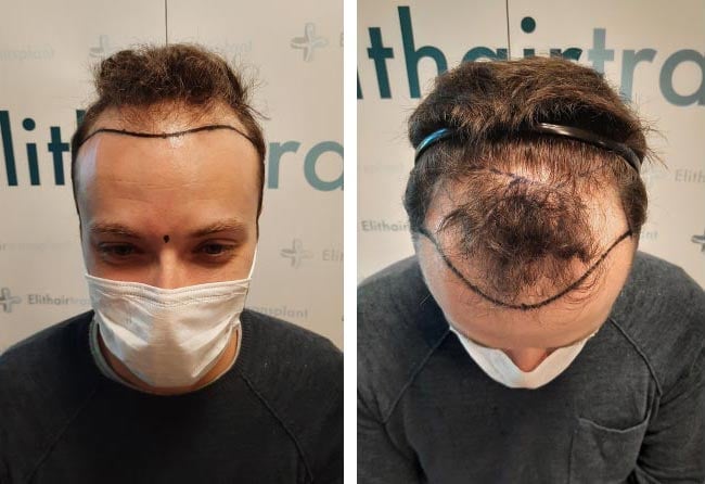 قبل عملية زراعة الشعر للسيد ديداك | مركز اليت هير