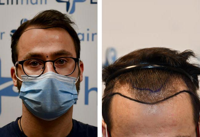 قبل عملية زراعة الشعر للسيد ريكاردو مركز اليت هير