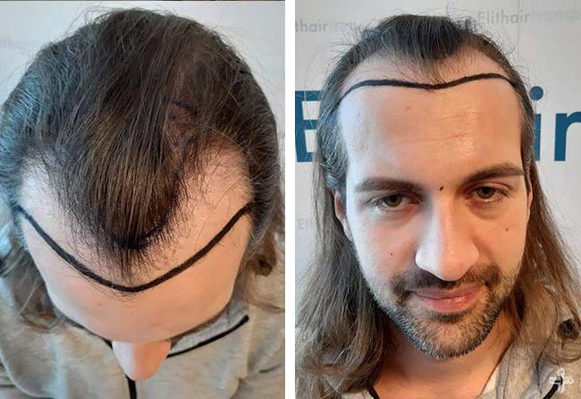 قبل عملية زراعة الشعر للسيد ساغاتي | بمركز اليت هير