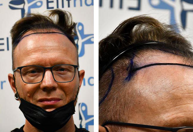 قبل عملية زراعة الشعر للسيد ستيفن مركز اليت هير