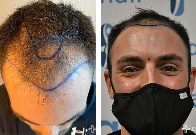 قبل عملية زراعة الشعر للسيد سيباستيان مركز اليت هير