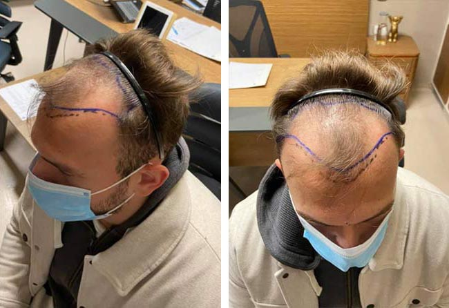 قبل عملية زراعة الشعر للسيد سيفكيت | اليت هير