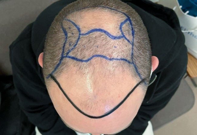 قبل عملية زراعة الشعر للسيد كريس مركز اليت هير