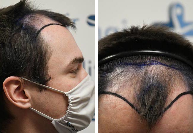 قبل عملية زراعة الشعر للسيد كريس | مركز إليت هير