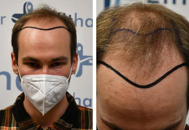 قبل عملية زراعة الشعر للسيد مارسيل | مركز اليت هير