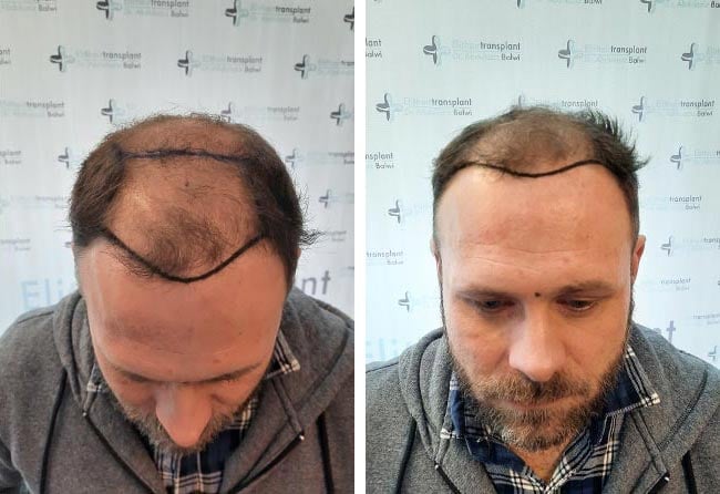 قبل عملية زراعة الشعر للسيد مايكل | اليت هير