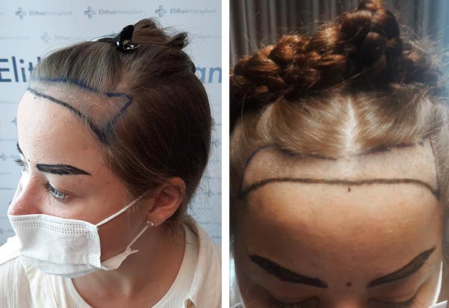 قبل عملية زراعة الشعر للسيدة ليليانا مركز اليت هير