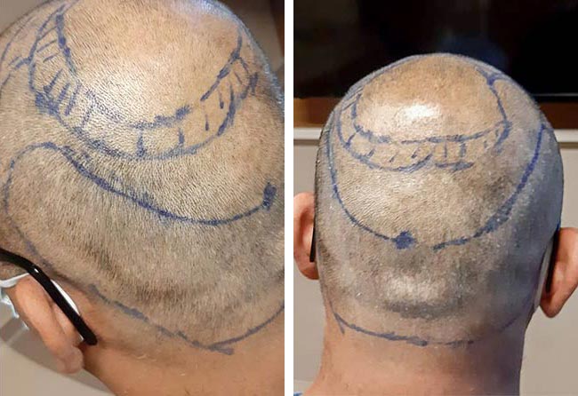قبل عملية زراعة شعر للسيد شهيد مركز اليت هير