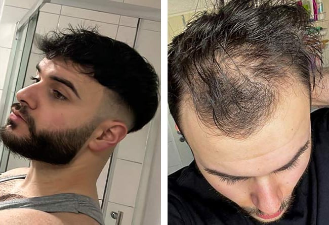 قبل وبعد عملية زراعة الشعر للسيد أوكان | مركز اليت هير