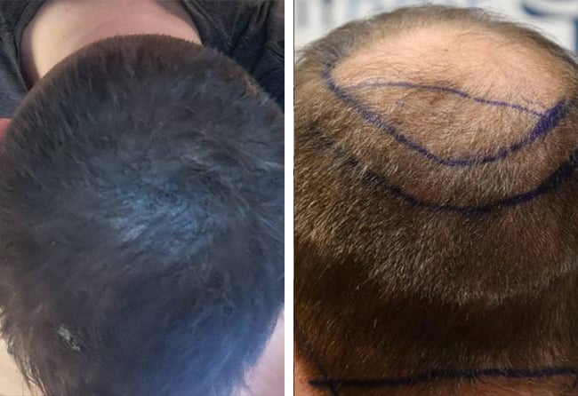 قبل وبعد عملية زراعة الشعر للسيد باتريك مركز اليت هير