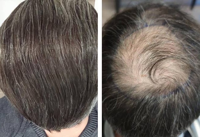 قبل وبعد عملية زراعة الشعر للسيد داني مركز اليت هير