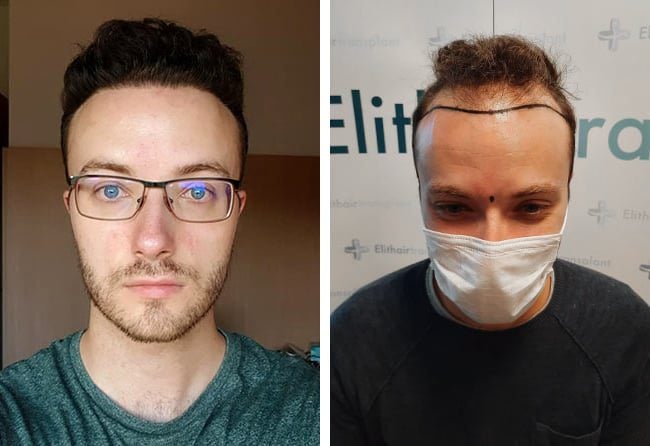 قبل وبعد عملية زراعة الشعر للسيد ديداك | مركز اليت هير