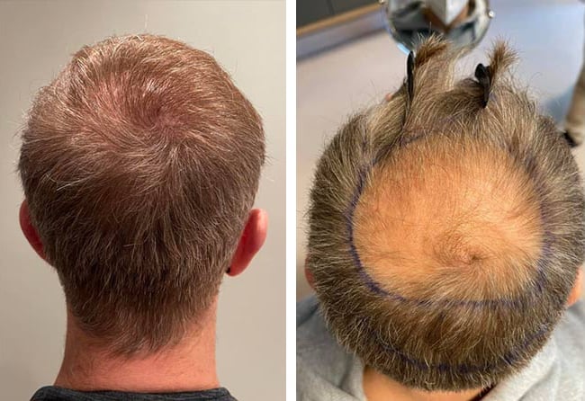 قبل وبعد عملية زراعة الشعر للسيد رفاييل مركز اليت هير