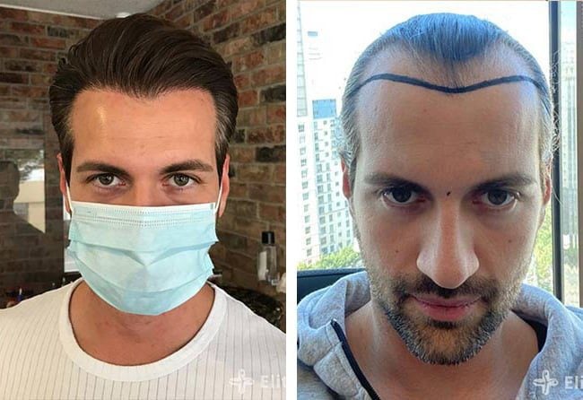 قبل وبعد عملية زراعة الشعر للسيد ساغاتي | بمركز اليت هير