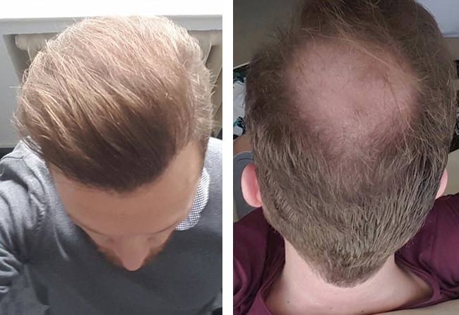 قبل وبعد عملية زراعة الشعر للسيد ستيفان مركز اليت هير