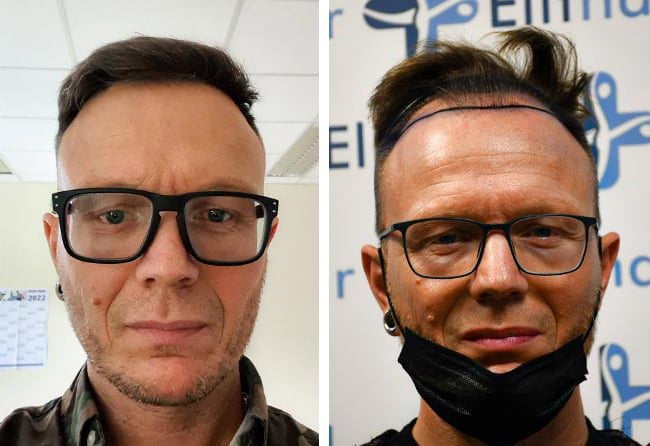 قبل وبعد عملية زراعة الشعر للسيد ستيفن مركز اليت هير
