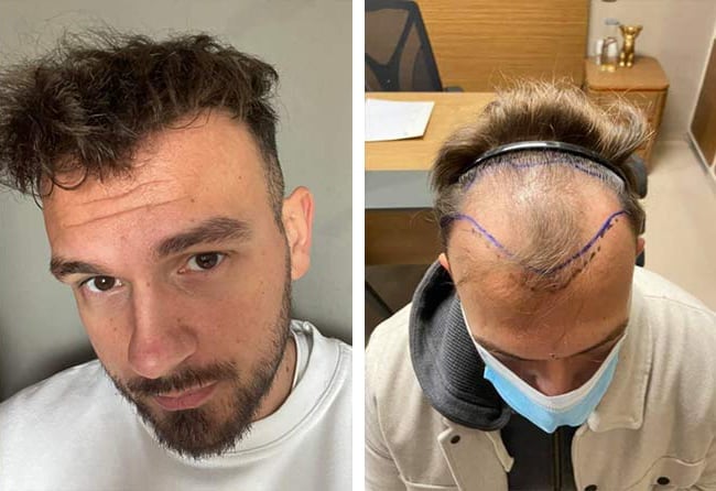 قبل وبعد عملية زراعة الشعر للسيد سيفكيت | اليت هير