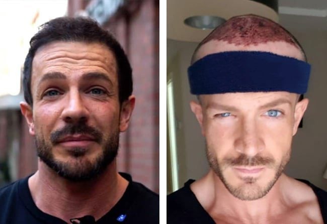 قبل وبعد عملية زراعة الشعر للسيد سيمون | بمركز اليت هير