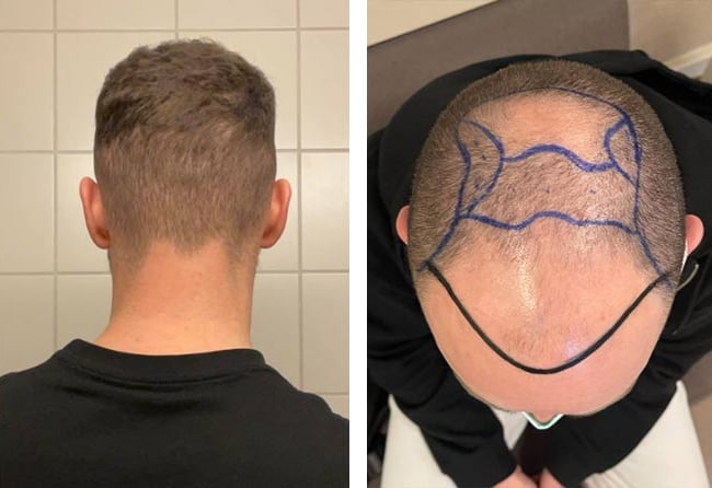 قبل وبعد عملية زراعة الشعر للسيد كريس مركز اليت هير