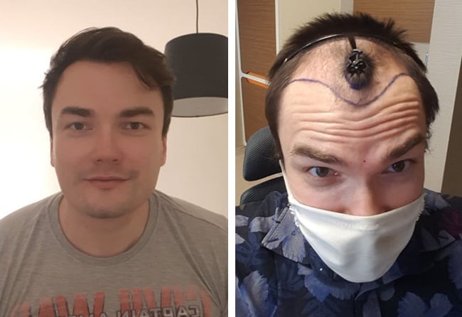 قبل وبعد عملية زراعة الشعر للسيد كريس | مركز اليت هير