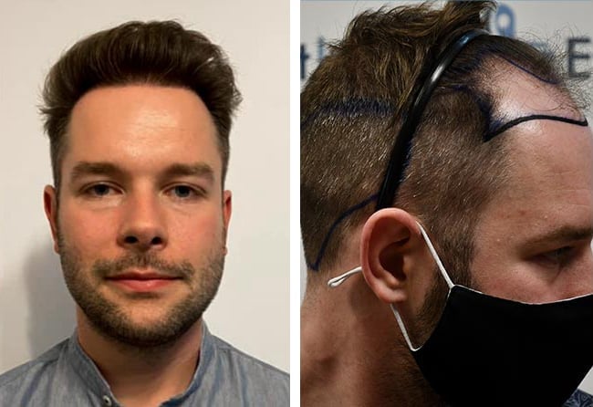 قبل وبعد عملية زراعة الشعر للسيد مايكل اليت هير