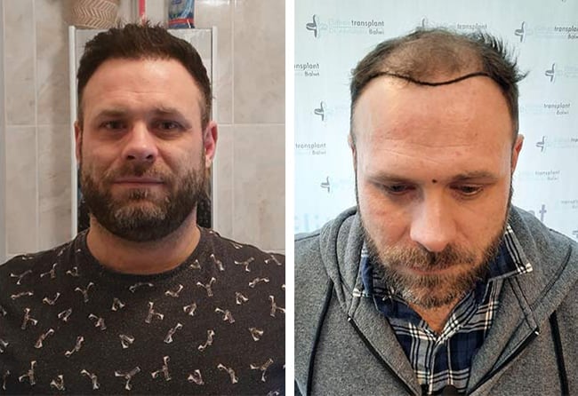 قبل وبعد عملية زراعة الشعر للسيد مايكل | اليت هير