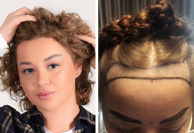 قبل وبعد عملية زراعة الشعر للسيدة ليليانا مركز اليت هير