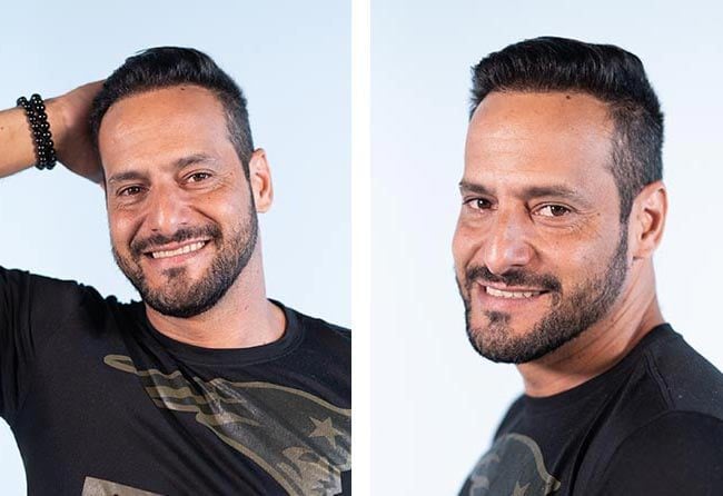 نتائج زراعة شعر للسيد راوديرسون مركز اليت هير