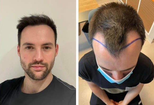 نتائج عملية زراعة الشعر للسيد اليكسنرا