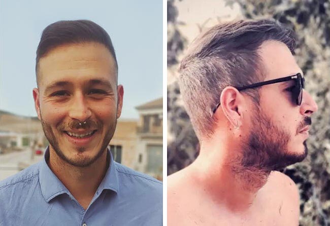 نتائج عملية زراعة الشعر للسيد خورخي مركز اليت هير