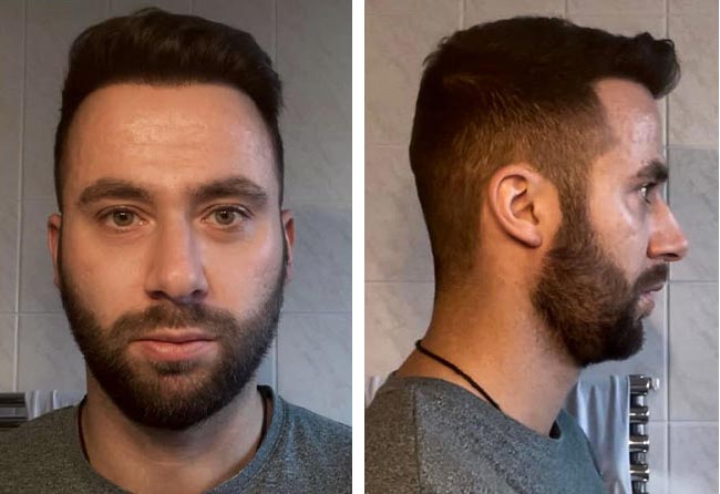 نتائج عملية زراعة الشعر للسيد ريكاردو مركز اليت هير