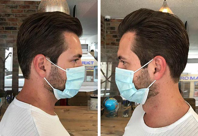 نتائج عملية زراعة الشعر للسيد ساغاتي | بمركز اليت هير