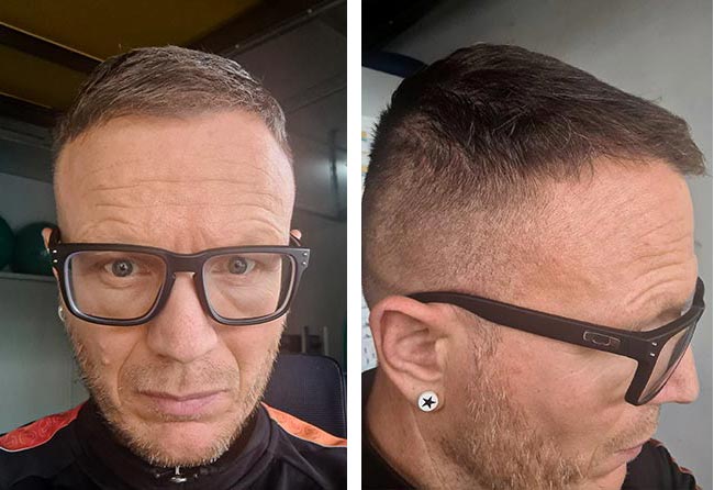 نتائج عملية زراعة الشعر للسيد ستيفن مركز اليت هير